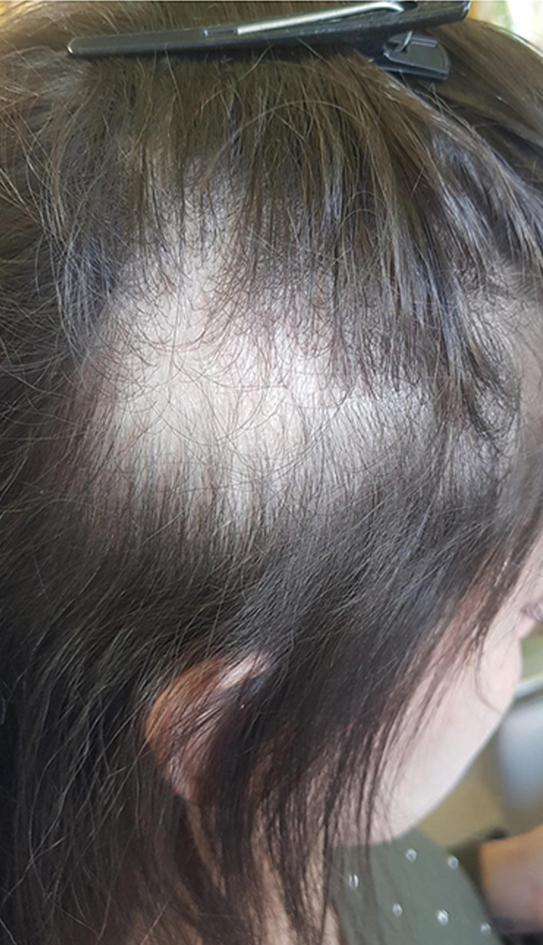 Capilar-1-1 Capilar-1-1