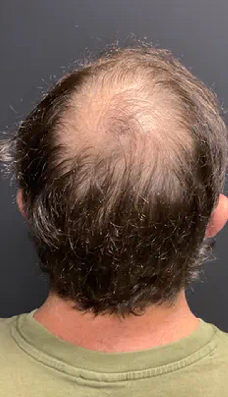 Capilar-3-1 Capilar-3-1