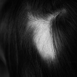 Woman hair loss. Head of woman on part of skin of which there is no hair. Maybe this is alopecia areata, lichen, trichopetia, microsporia. Close-up